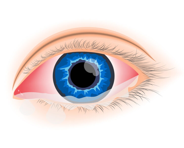 Allergic Conjunctivitis (Pink Eye)