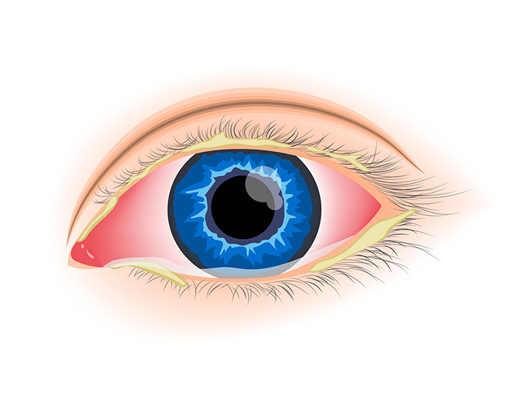Bacterial Conjunctivitis (Pink Eye) Bacterial Conjunctivitis (Pink Eye)